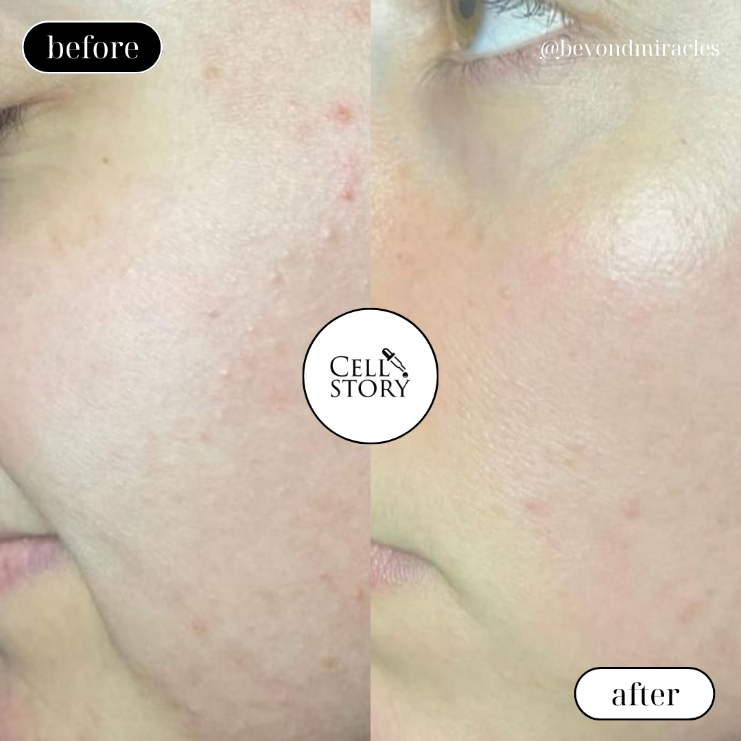 Cell Story Liquid Microneedling: Block of 2