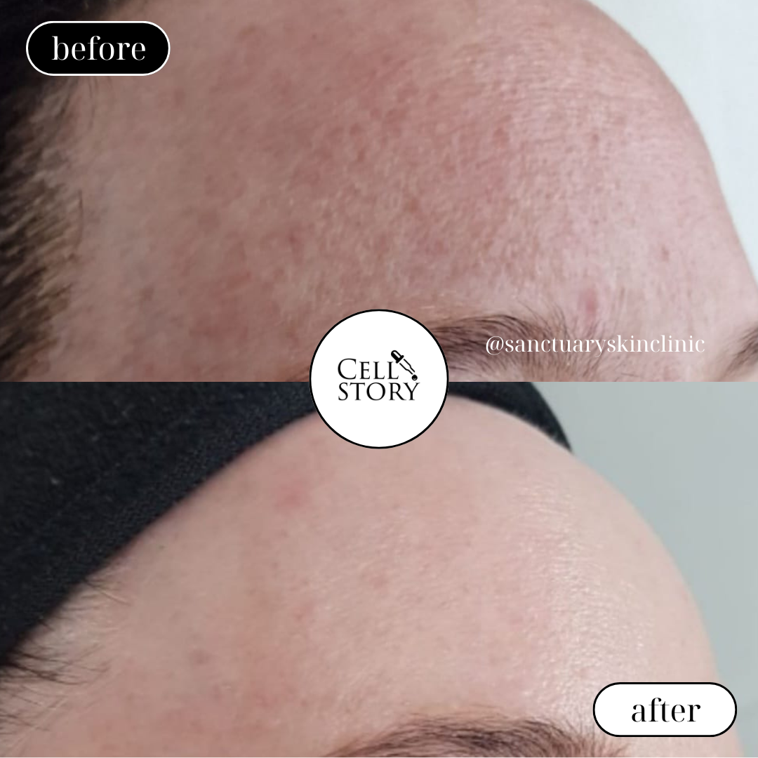 Cell Story Liquid Microneedling: Block of 2