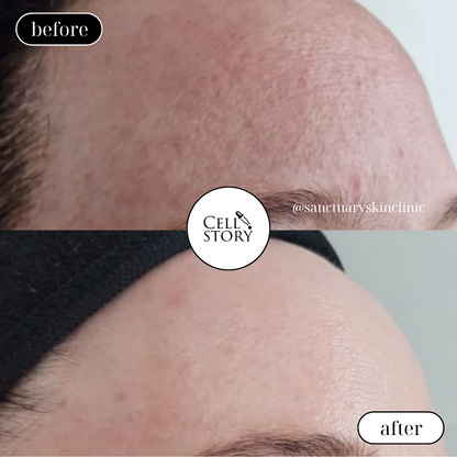 Cell Story Liquid Microneedling: Block of 2