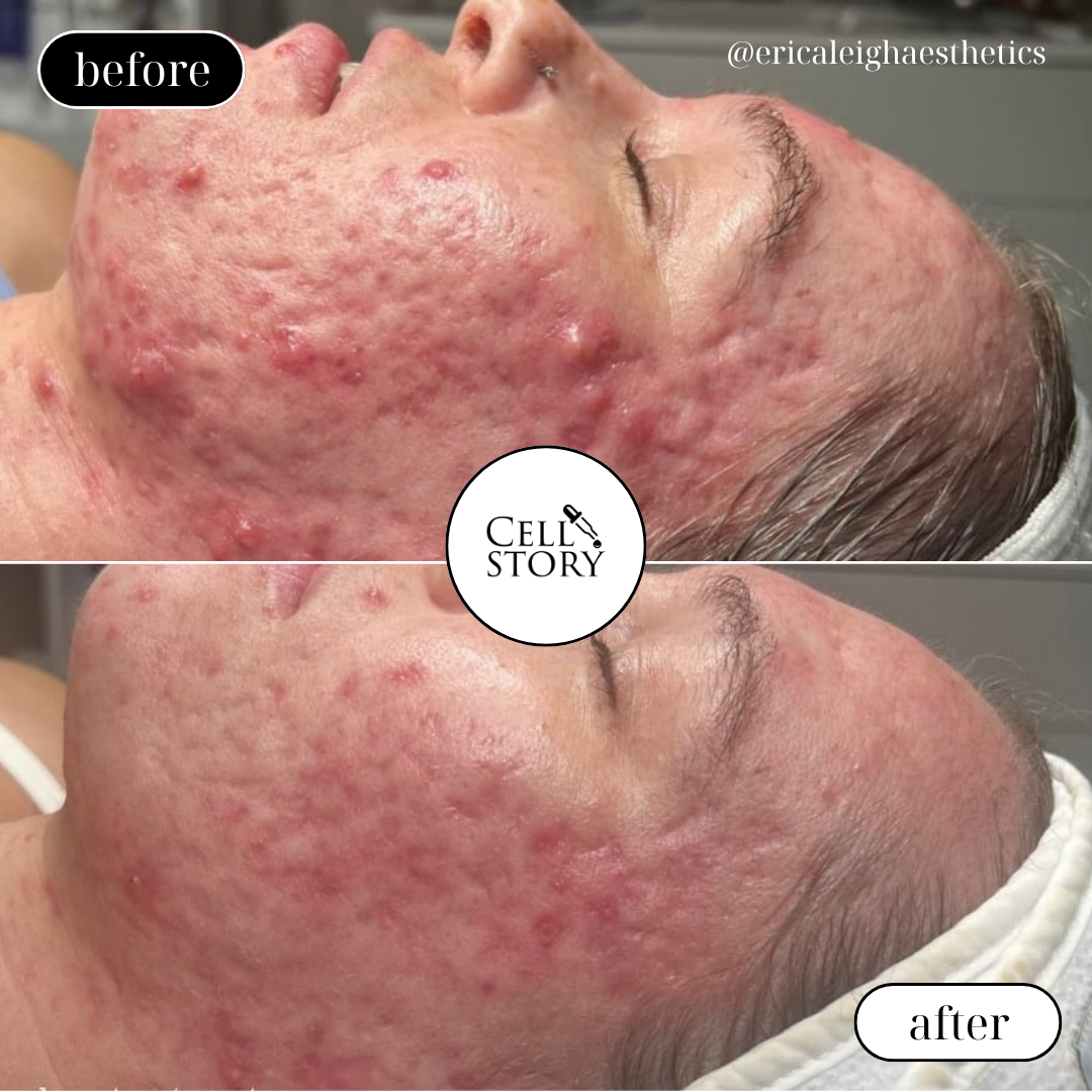 CellStory Liquid Microneedling: 4 Week Transformation
