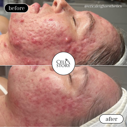 CellStory Liquid Microneedling: 4 Week Transformation