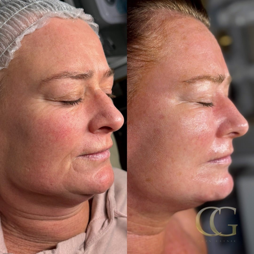 RF Microneedling Full Face: Block of 3