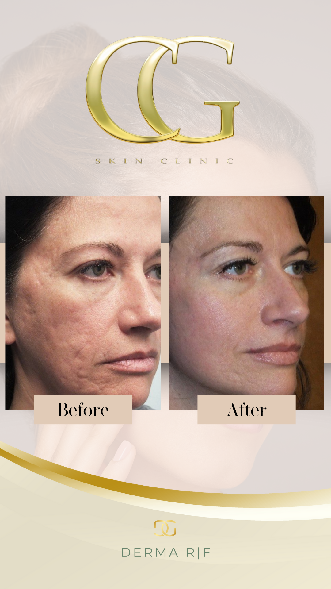 RF Microneedling Full Face: Block of 3