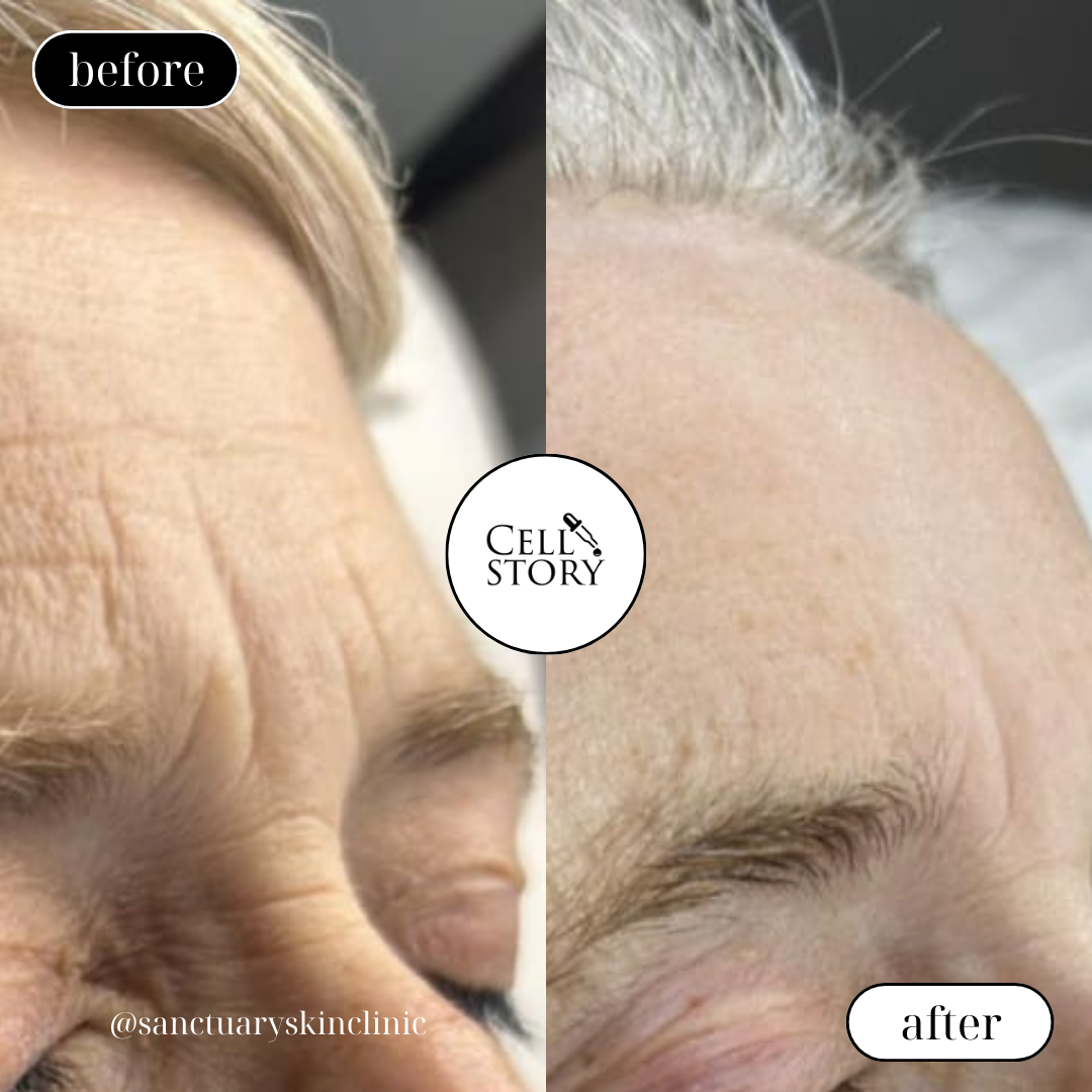 CellStory Liquid Microneedling: 4 Week Transformation