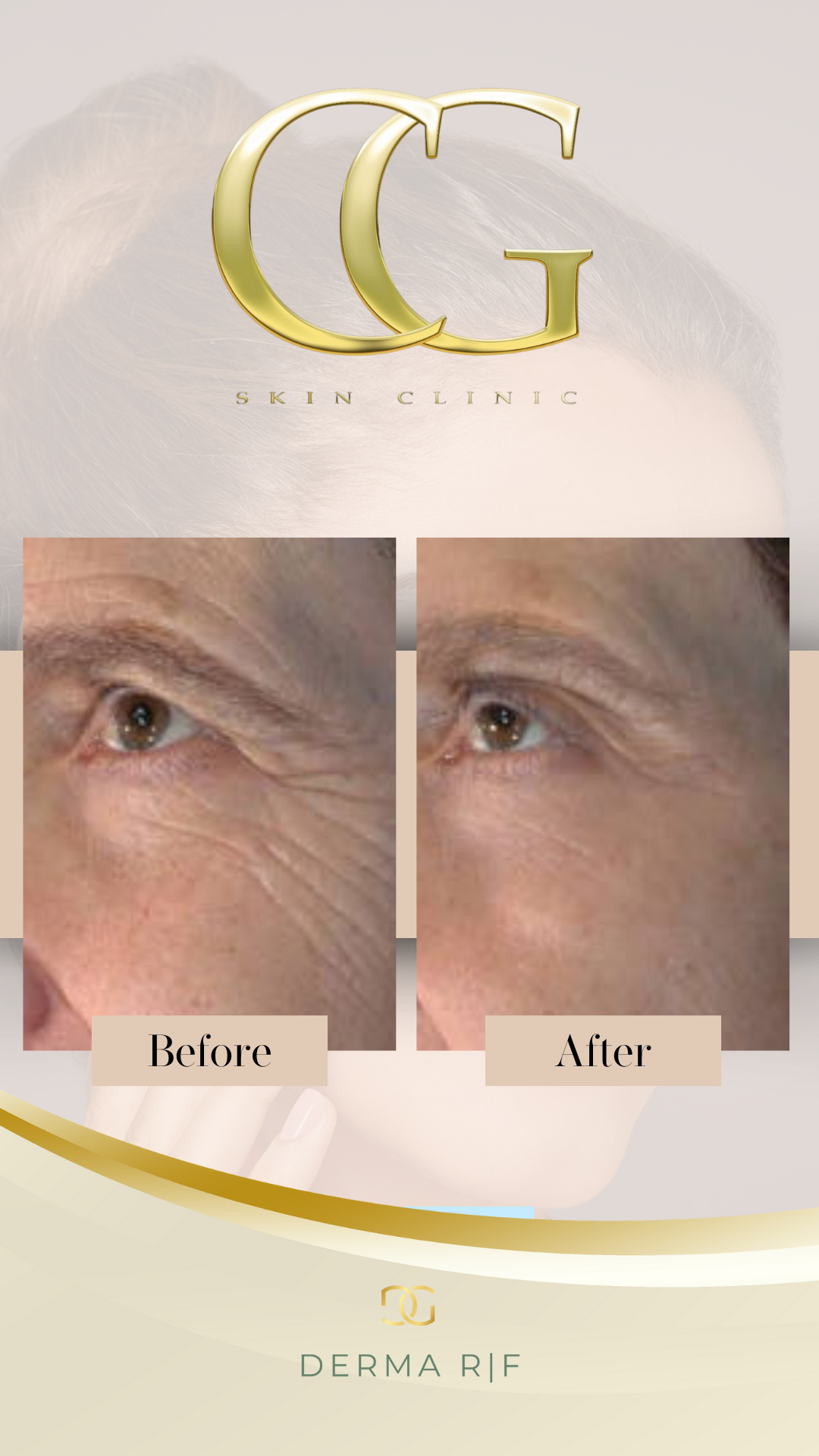 RF Eyes: Block of 3