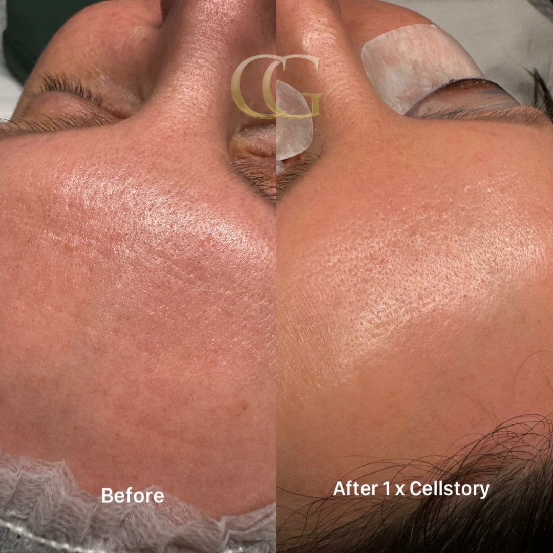 Cell Story Liquid Microneedling