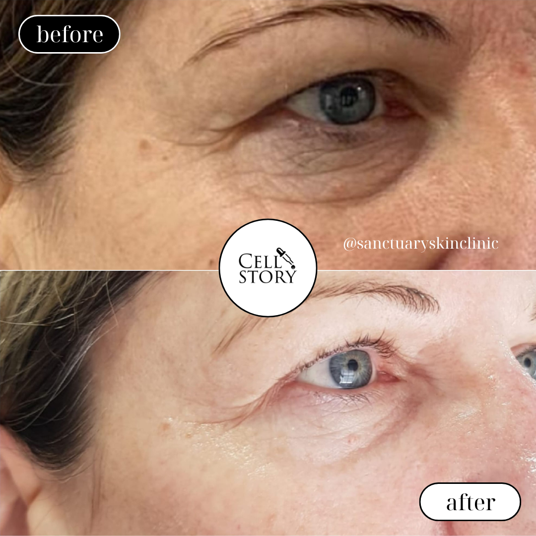 CellStory Liquid Microneedling: 4 Week Transformation