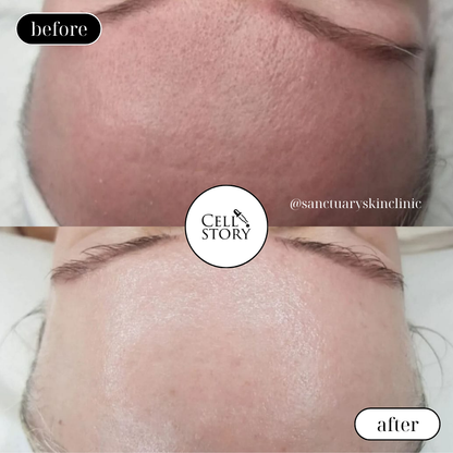 Cell Story Liquid Microneedling: Block of 2