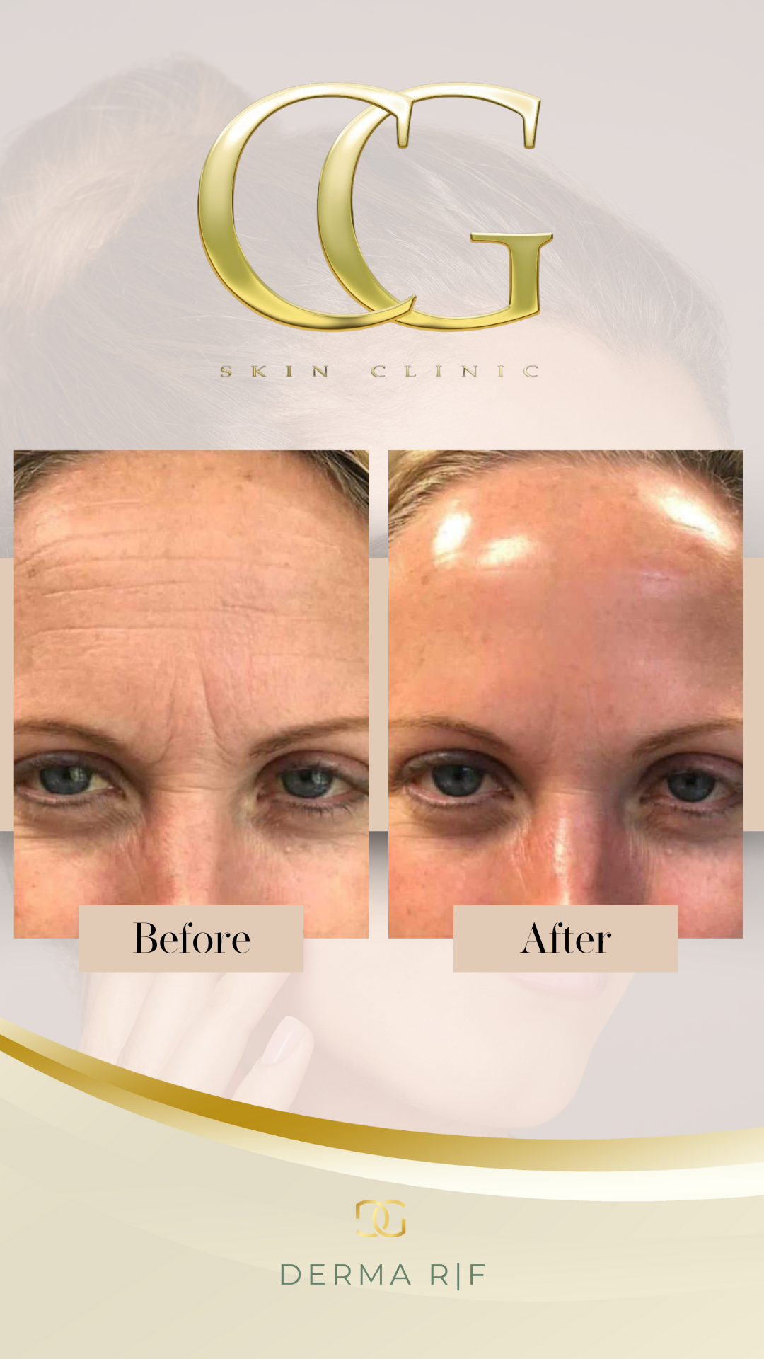 RF Forehead: Block of 3