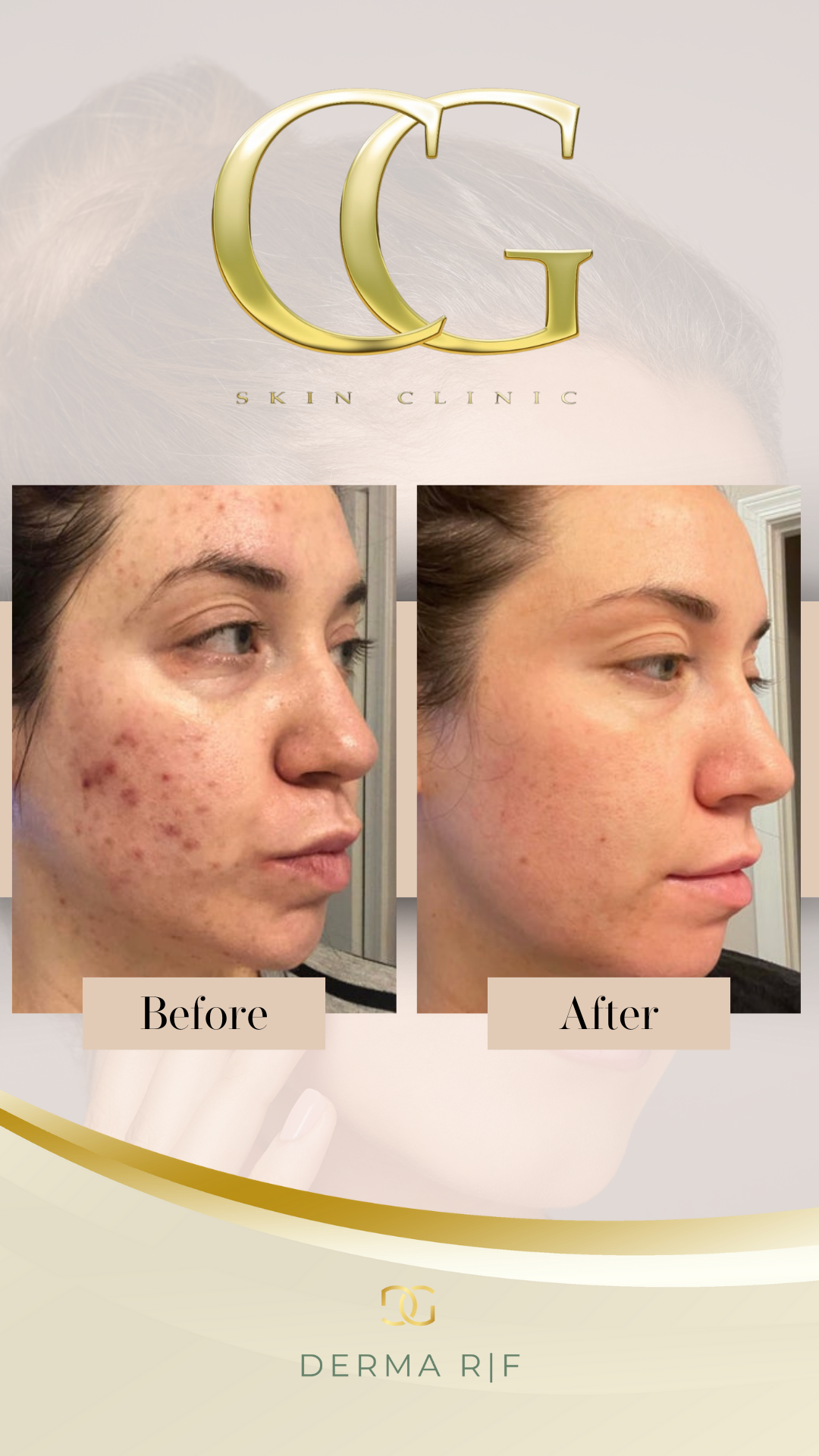 RF Microneedling Full Face: Block of 3