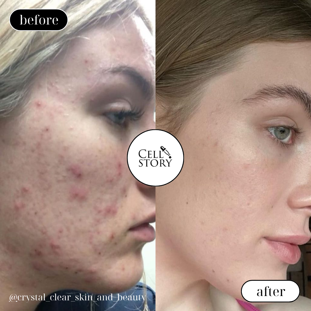 CellStory Liquid Microneedling: 4 Week Transformation