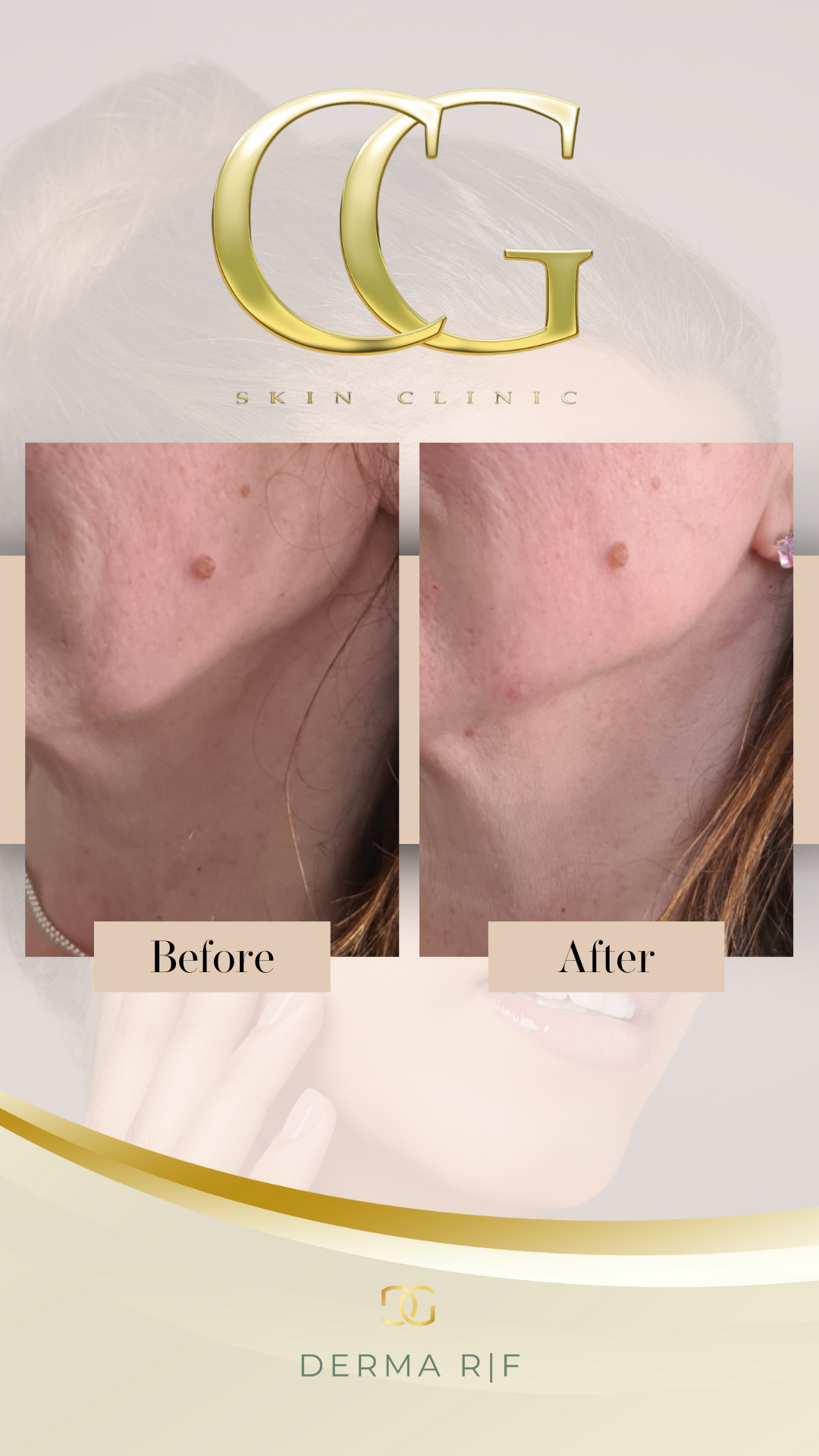 RF Microneedling Lower Face: Block of 3