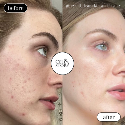 CellStory Liquid Microneedling: 4 Week Transformation