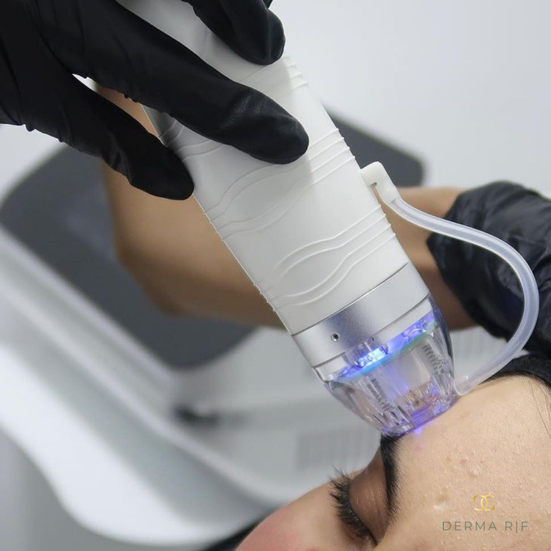RF Microneedling Face + Neck: Block of 3